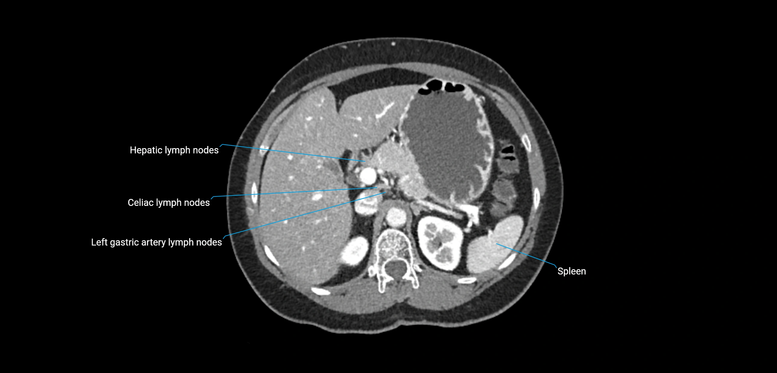 CT ct abdominal lymph nodes  axial cross sectional anatomy  enchanced radiology image -img-00002-00139.webp